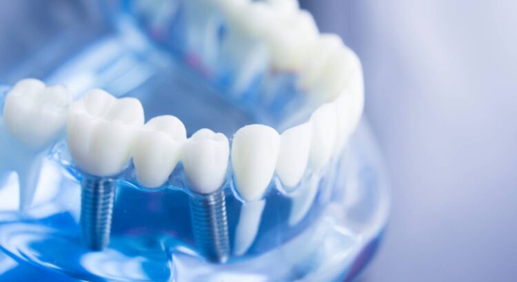 Implanty dentystyczne – czy mogą zastąpić prawdziwe zęby?