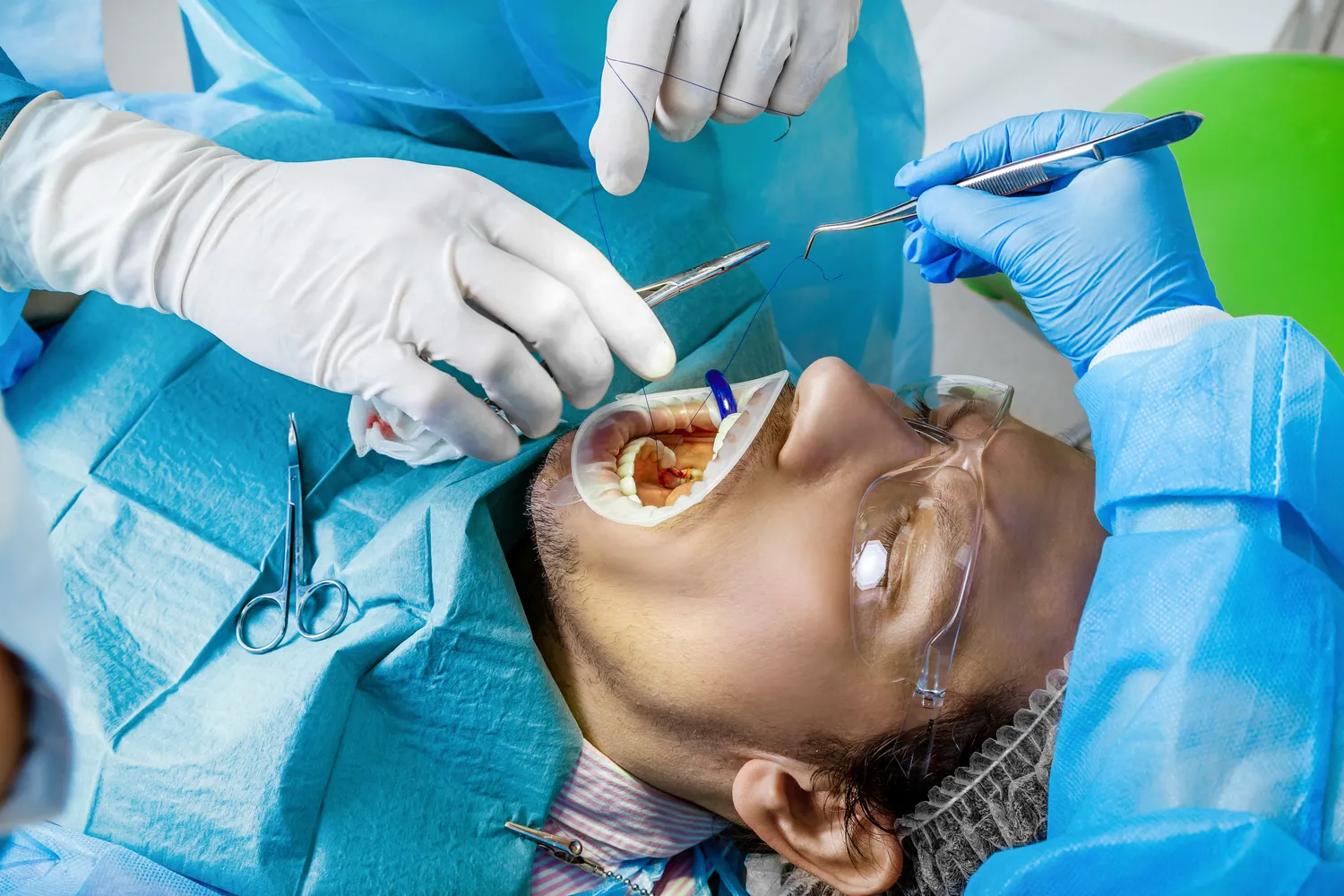 Metody powiększania ust kwasem