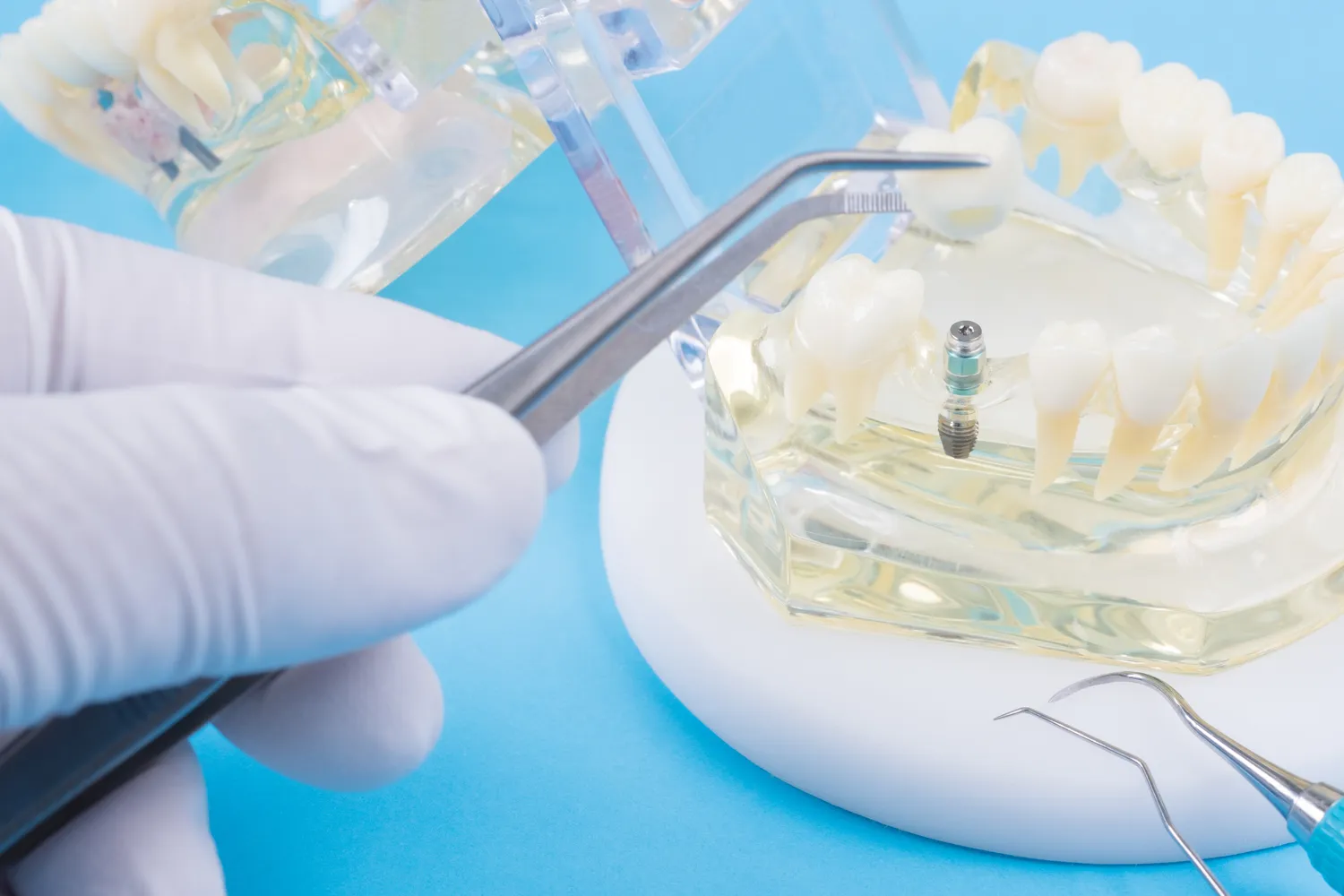 Ile kosztuje implanty?